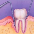 Do I Have Gum Disease? What Are The Signs And Symptoms?