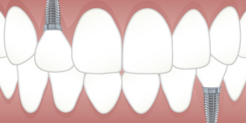 Dental Bridges vs. Implants: A Comprehensive Guide
