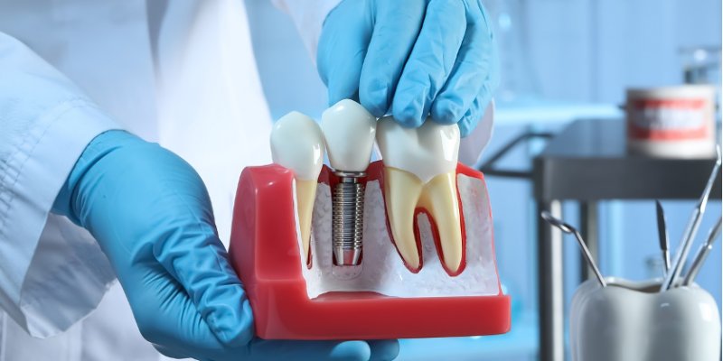 Dental Implant Grants: Scam or Real?