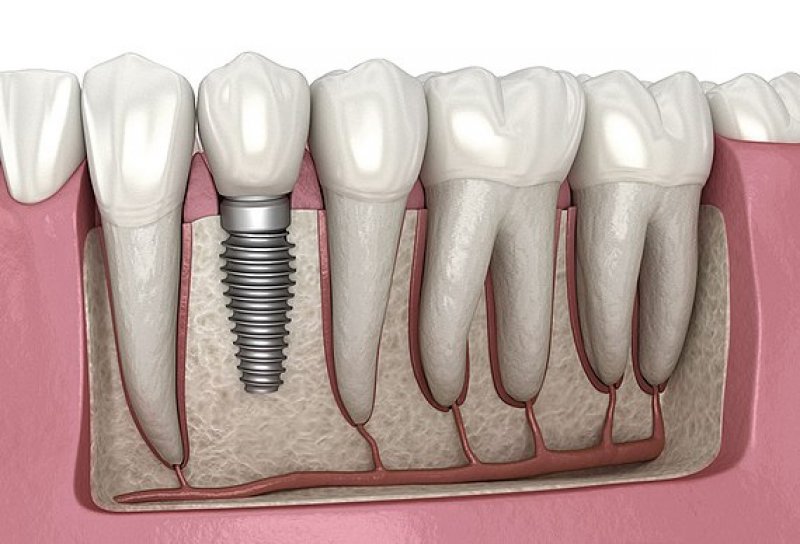 Understanding Dental Implants