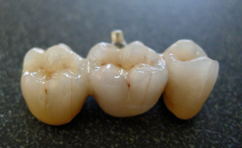 Understanding Dental Bridges