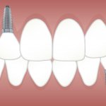 Dental Bridges vs. Implants: A Comprehensive Guide