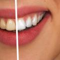 How Teeth Whiteners Work