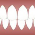 What Can You Do To Get Whiter Teeth From Home?