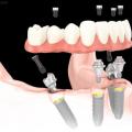 The Advantages of All On 4 Dental Implants