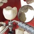 Several Benefits of Jacksonville Dental Implants