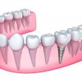 An Introduction to Mini Dental Implant Procedure