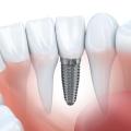 3 Types Of Dental Implants And Their Benefits