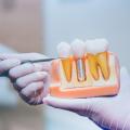 8 Questions To Ask Your Dentist Before Getting Dental Implants