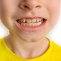 Why is Malocclusion a Common Dental Condition?