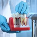 Dental Implant Grants: Scam or Real?